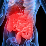 CBD et maladie de Crohn