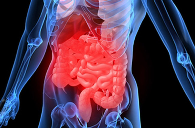 CBD e malattia di Crohn