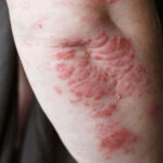 pikkelysömör a karon